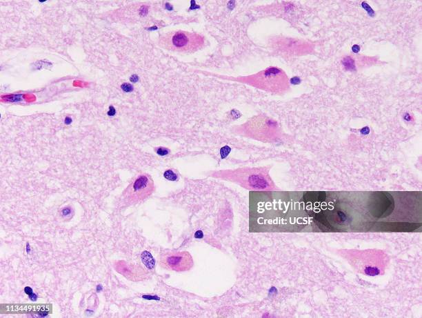brain hypoxia, hippocampus, neurons - light micrograph stock pictures, royalty-free photos & images