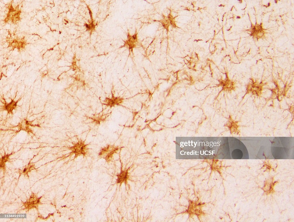 Reactive astrocytes