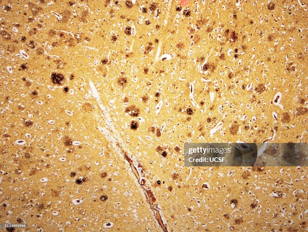 Alzheimer's disease, neuritic plaques