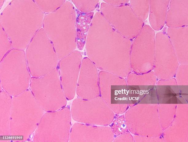 pompe disease, myopathy, glycogen storage - glycogen storage disease type ii stock pictures, royalty-free photos & images