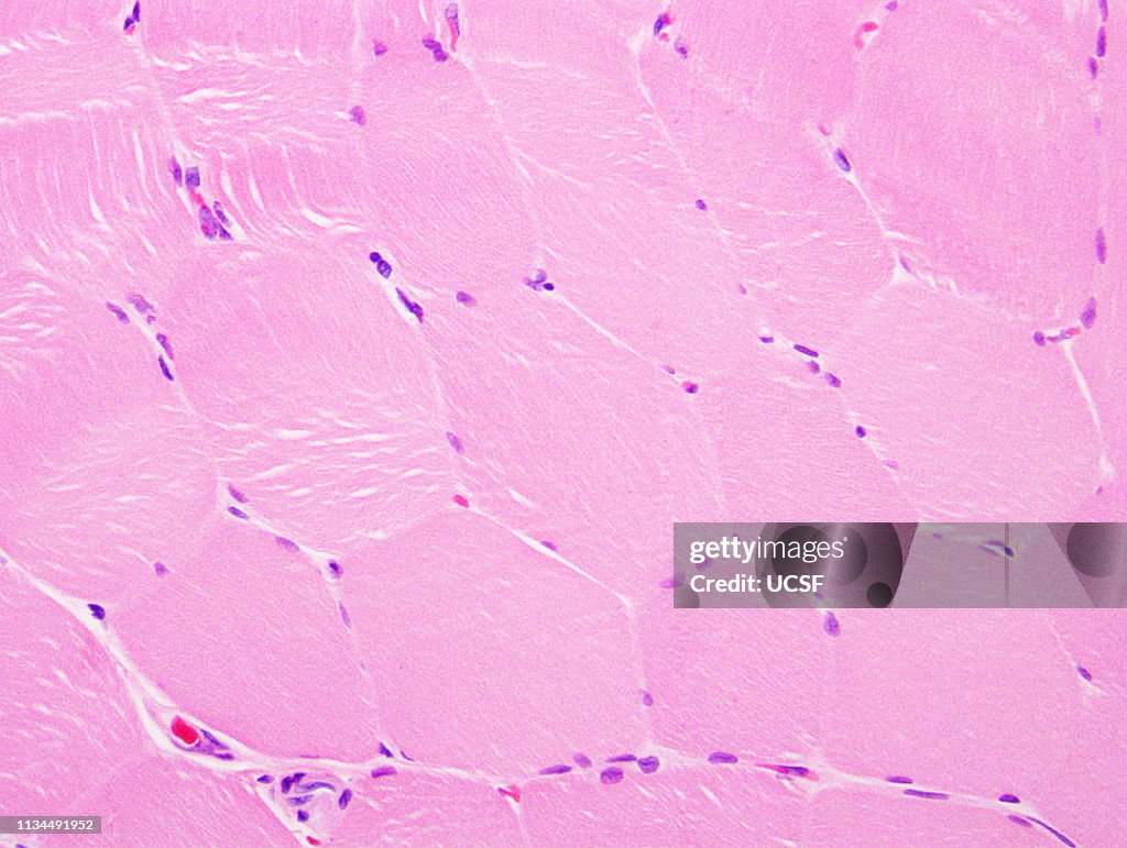Normal muscle