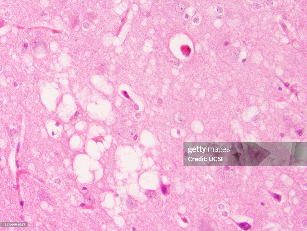 Prion disease, spongiform encephalopathy