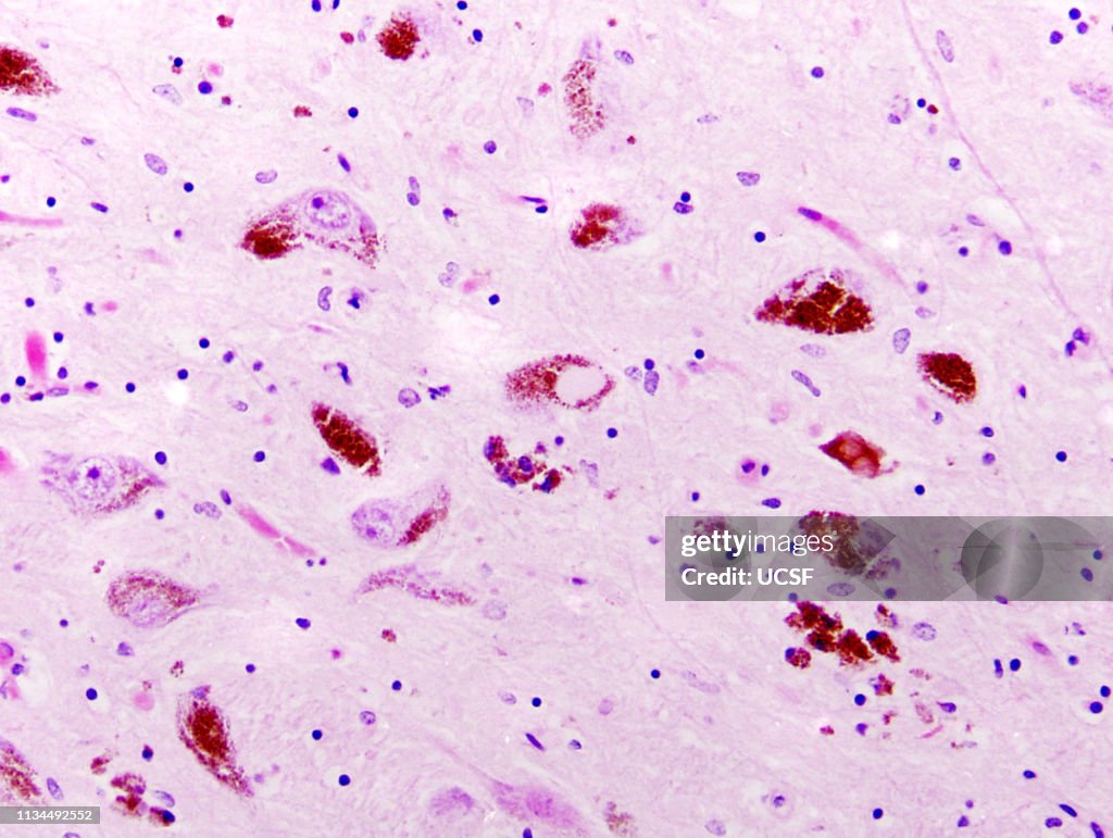 Parkinson's disease, substantia nigra, Lewy bodies