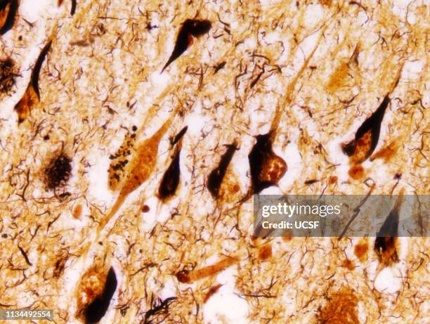 alzheimer's disease, neurofibrillary tangles - neurofibrillary tangle stock pictures, royalty-free photos & images
