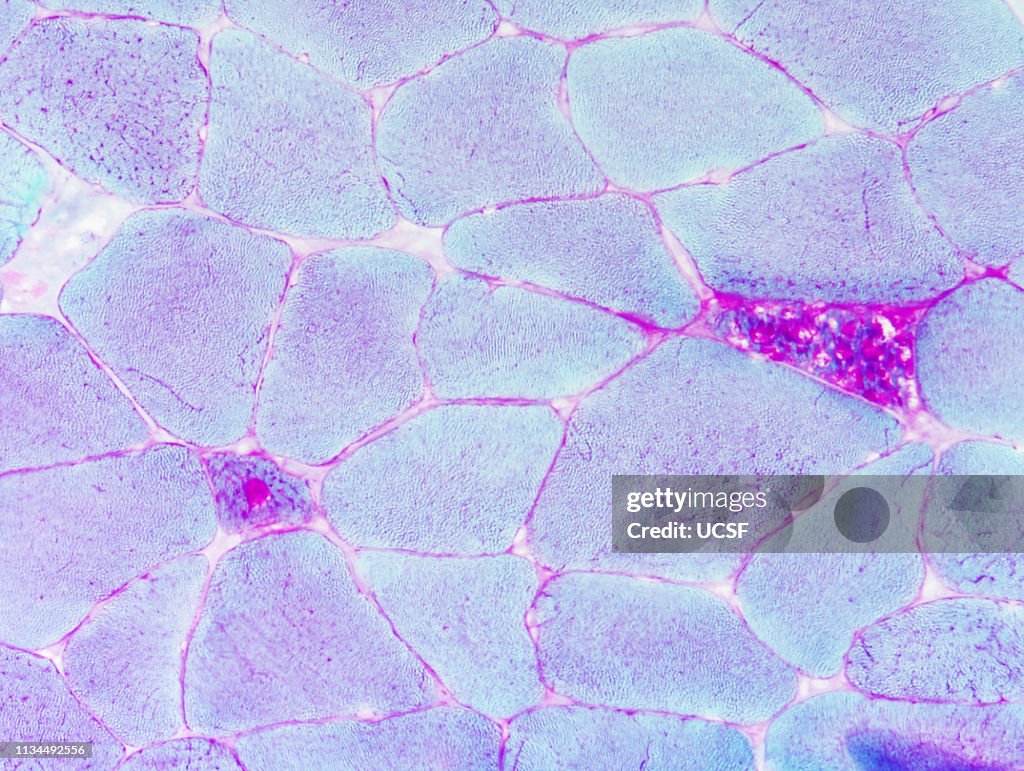 Pompe disease, glycogen storage, myopathy