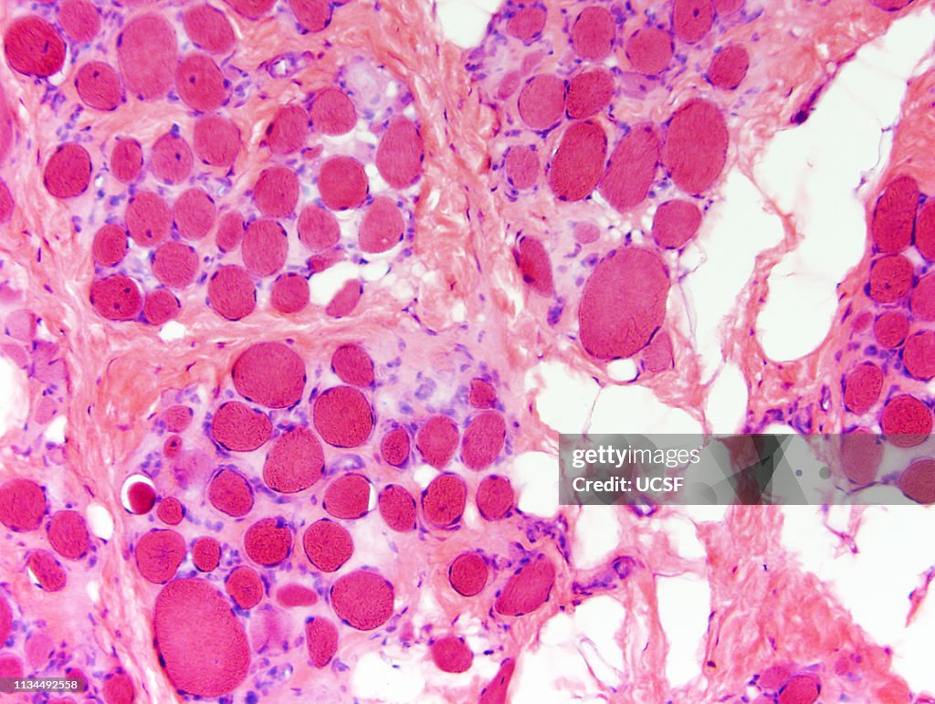 Muscular dystrophy