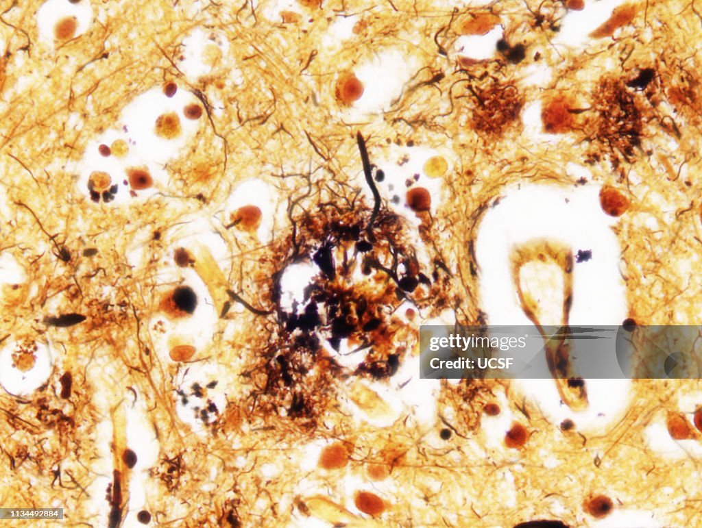 Alzheimer's disease, neuritic plaques