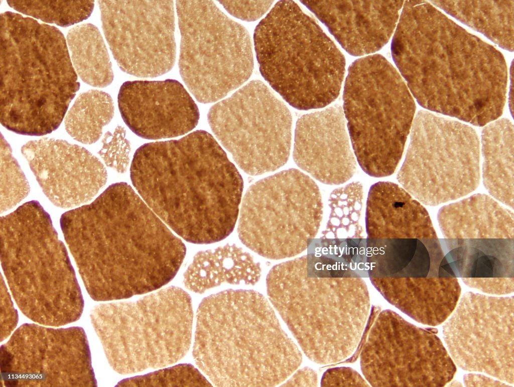 Pompe disease, glycogen storage, myopathy