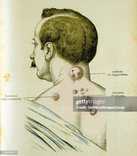 Exploding Pustules 72 Pustules Stock Photos, High-Res Pictures, and Images - Getty Images