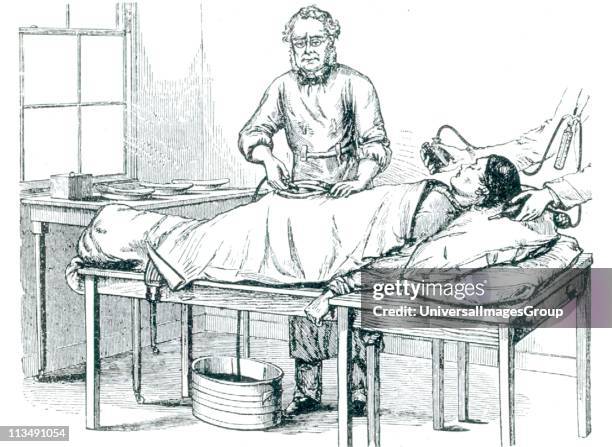 Thomas Spencer Wells British gynaecolotist who perfected ovariotomy, performing an operation on a patient anaesthetised by chloroform, c1870.