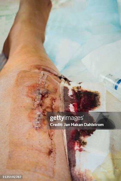 changing bandages after knee surgery - surgery stitches stock pictures, royalty-free photos & images