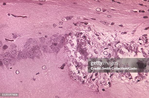 Hematoxylin-eosin stained photomicrograph of the cellular pathology associated with Tamiami virus encephalitis, 1972. Image courtesy Centers for...