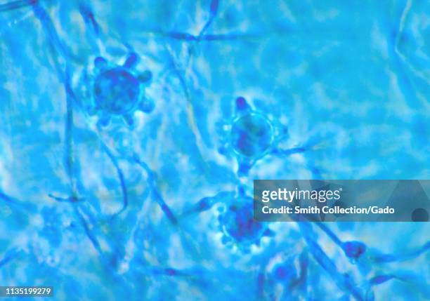 Photomicrograph of the multiple macroconidia of the fungus Histoplasma capsulatum, 1963. Image courtesy Centers for Disease Control and Prevention /...