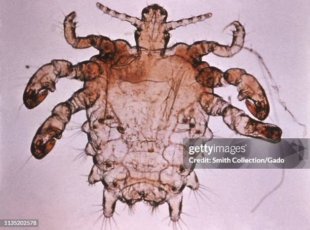 Photomicrograph of the Phthirus pubis , found in a human pubic hair, 1975. Image courtesy World Health Organization .