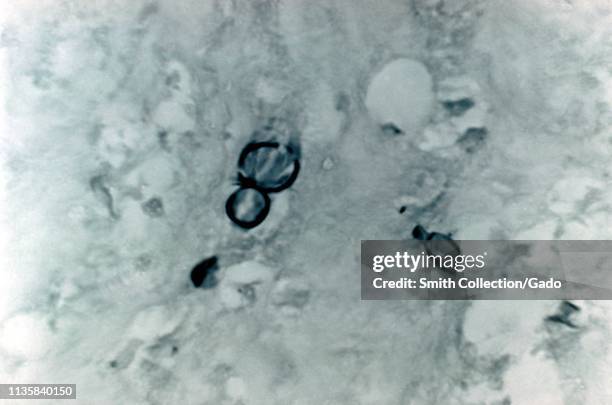 Methenamine silver stain photomicrograph of the histopathologic changes in blastomycosis due to Blastomyces dermatitidis, 1972. Image courtesy...