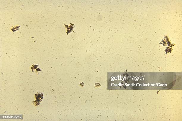 Unstained photomicrograph of the Venereal Disease Research Laboratory slide test for Syphilis, sexually transmitted disease caused by the bacterium...