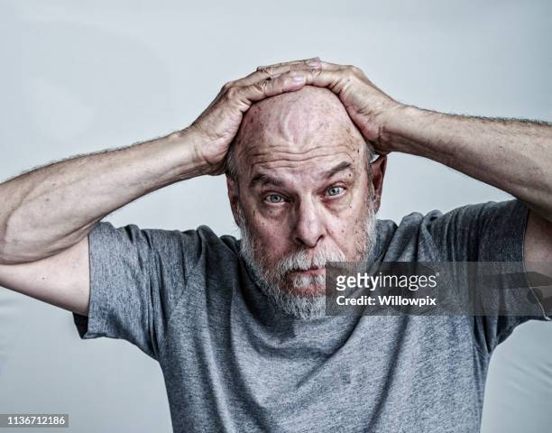 senior man kanker chemotherapie patiënt handen op het hoofd - mottled skin stockfoto's en -beelden
