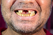 Toothless man, smiling man with yellowed teeth