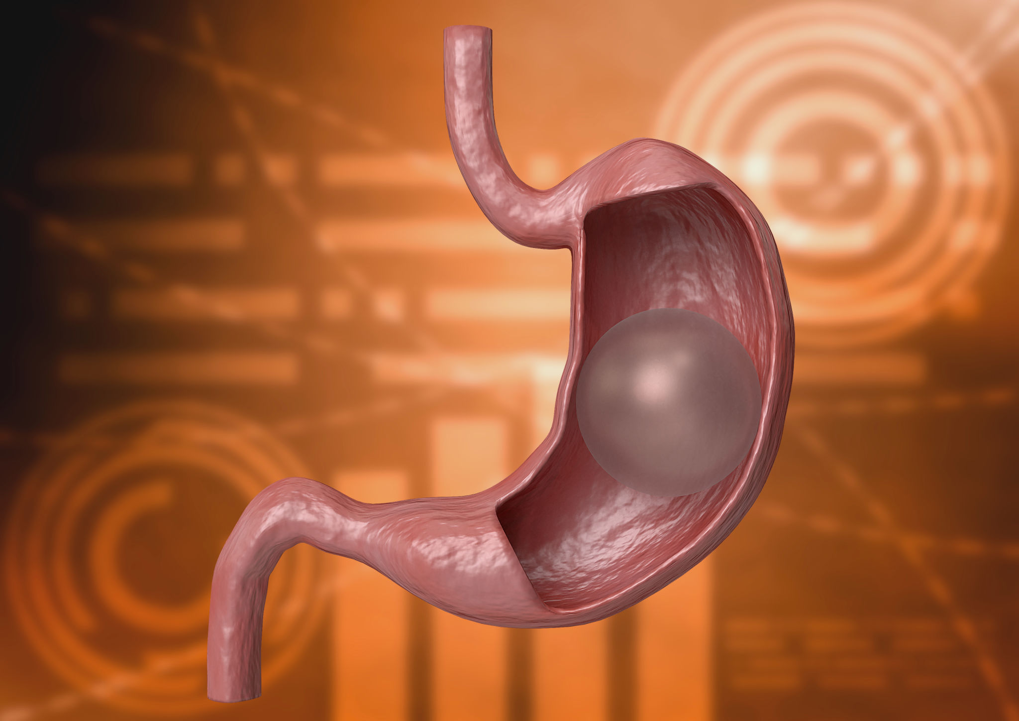 Balloon gastric 3D rendering. inflatable device that is placed in the stomach to reduce weight Balloon gastric 3D rendering. inflatable device that is placed in the stomach to reduce weight