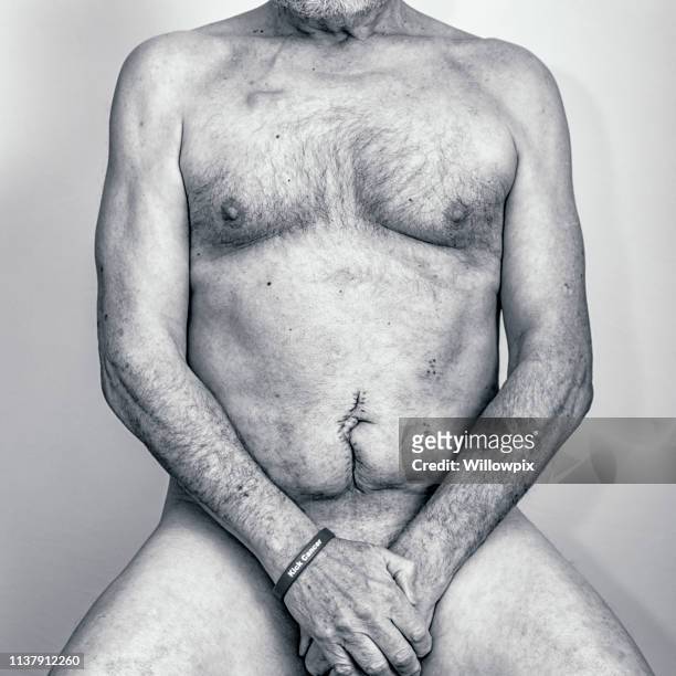 senior man cancer sobreviviente paciente médico recuperación después de la cirugía de cáncer colorrectal - hairy old man fotografías e imágenes de stock