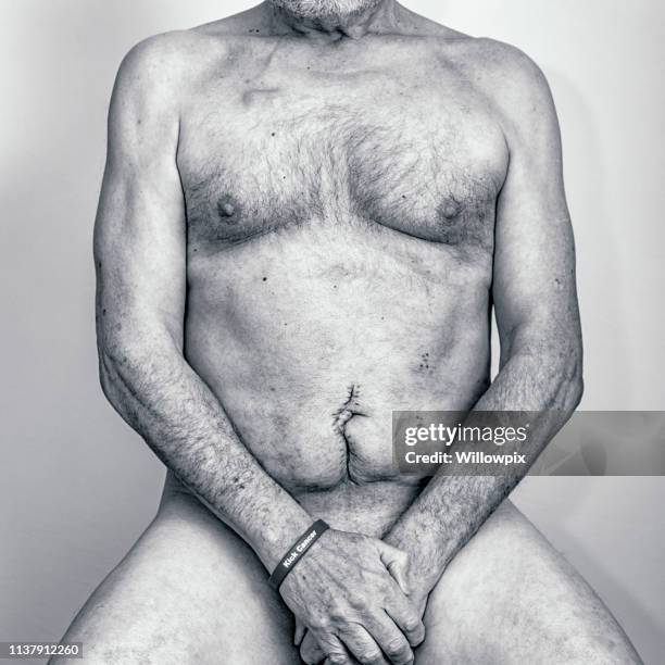 senior man cancer survivor medical patient recovering after colorectal cancer surgery - hairy old man stock pictures, royalty-free photos & images