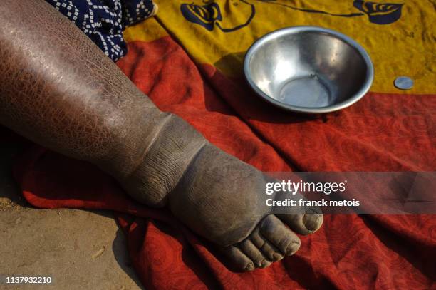 woman suffering from elephantiasis ( india) - elephantiasis stock pictures, royalty-free photos & images