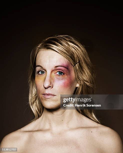 young woman with black eye - cardenal lesión física fotografías e imágenes de stock