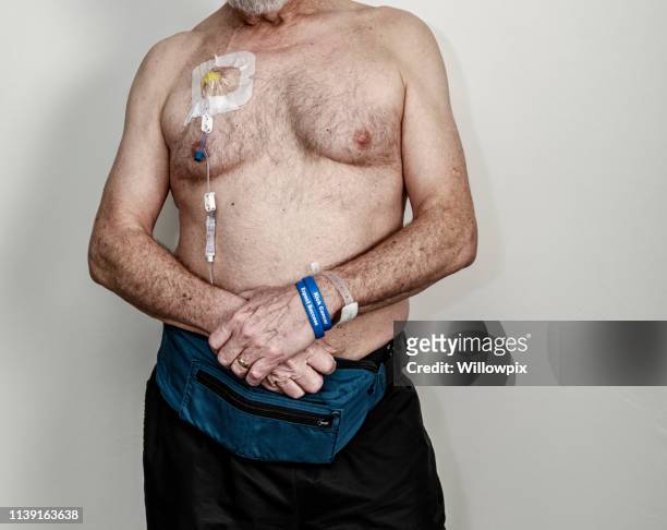 portable iv drip pump chemotherapy senior man cancer patient - chemotherapy man stock pictures, royalty-free photos & images