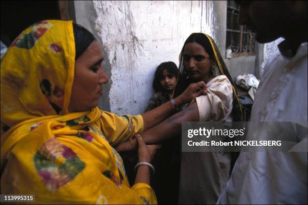 Illustration on conjugal violence disagreement of the DOT In India On May 31, 1995-Raj bala showing wounds received by beating from her in-laws.