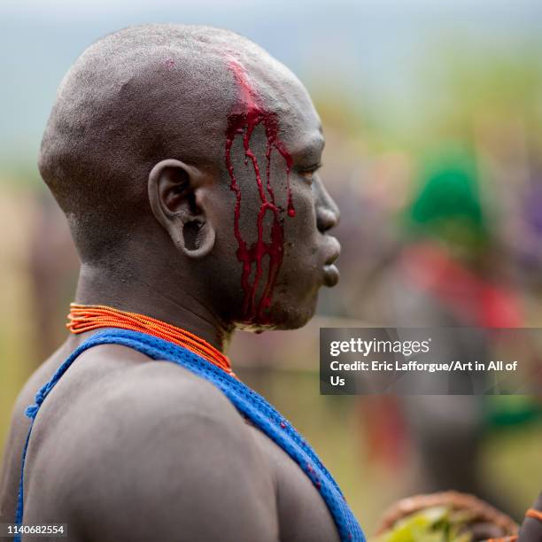 Man bleeding after he got hit during the donga stick fighting ritual in Surma tribe, Tulgit, Omo valley, Ethiopia on July 4, 2010 in Tulgit, Ethiopia.