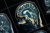 MRI of the patient's head close-up. One picture from the series