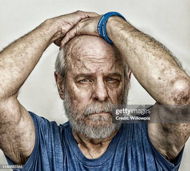 müde leitender mann krebs chemotherapie medizinischer patient - cancer portrait stock-fotos und bilder