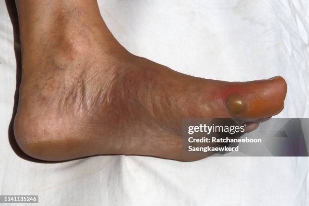 an abscess at a man's left toe. - blister stock pictures, royalty-free photos & images