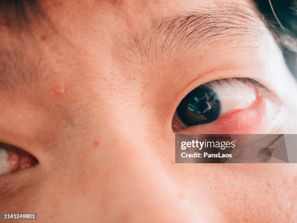 man with hordeolum ill eye - hordeolum stock pictures, royalty-free photos & images