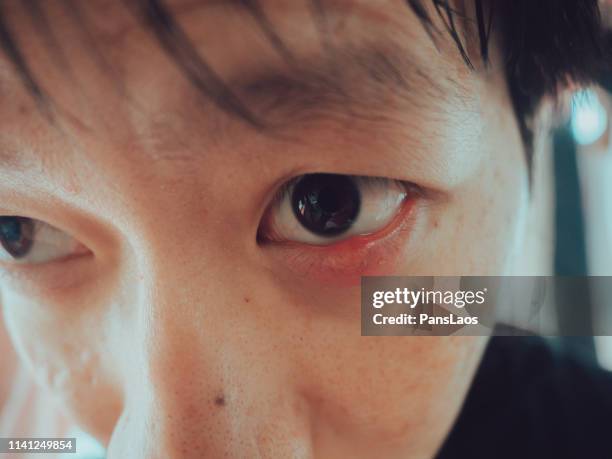 man with hordeolum ill eye - hordeolum stock pictures, royalty-free photos & images