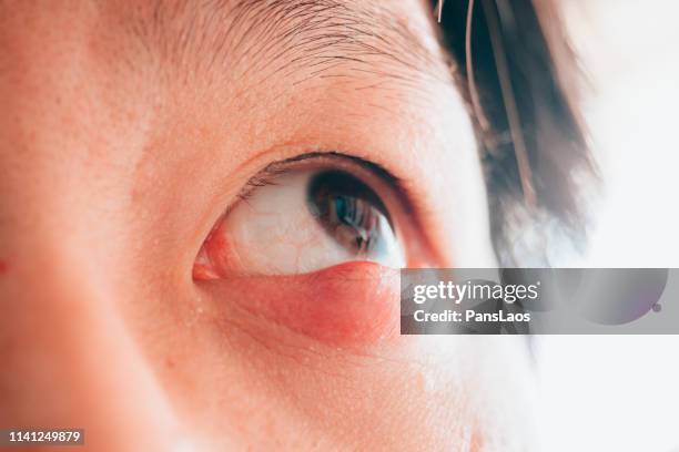 man with hordeolum ill eye - infected wound stock-fotos und bilder