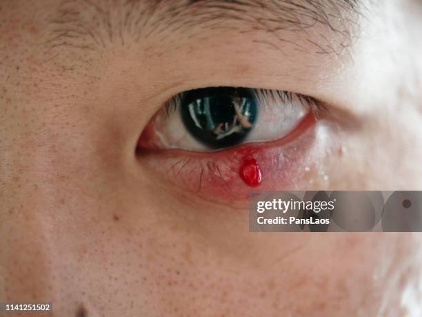 man with hordeolum ill eye - hordeolum stock pictures, royalty-free photos & images