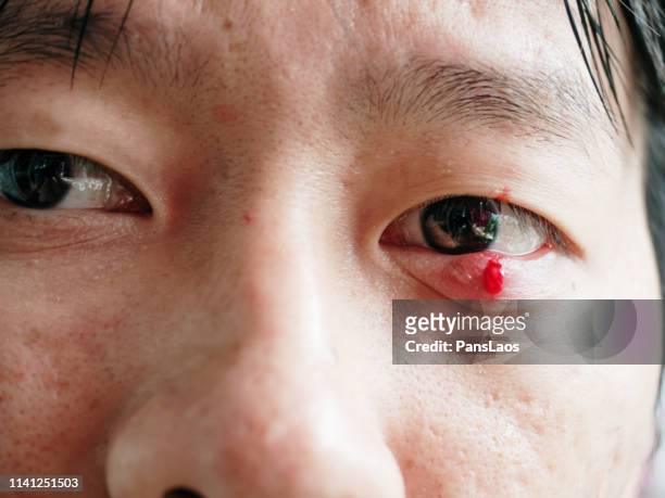man with hordeolum ill eye - hordeolum stockfoto's en -beelden