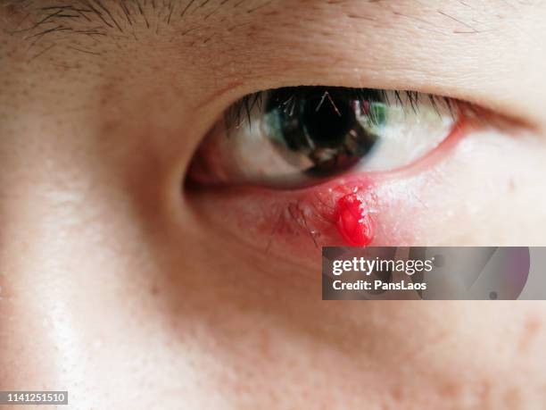 man with hordeolum ill eye - hordeolum stockfoto's en -beelden