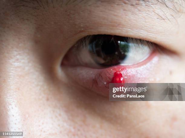 man with hordeolum ill eye - hordeolum stockfoto's en -beelden