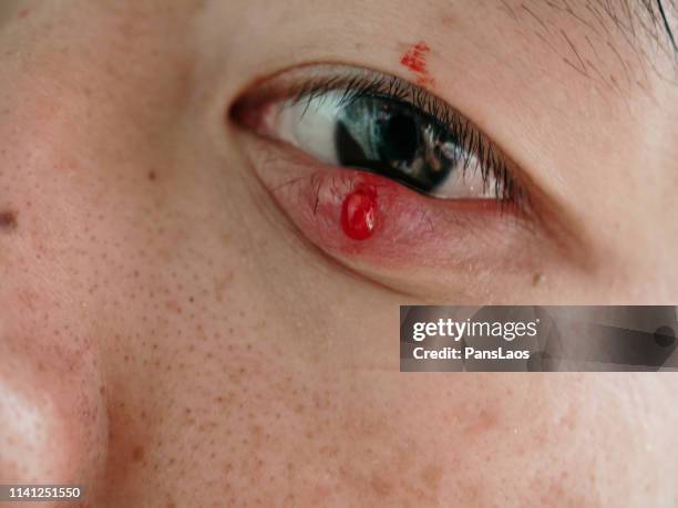 man with hordeolum ill eye - stile stock pictures, royalty-free photos & images