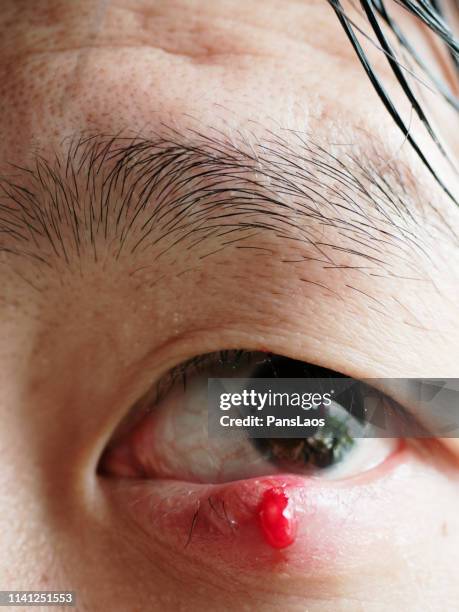 man with hordeolum ill eye - hordeolum stockfoto's en -beelden