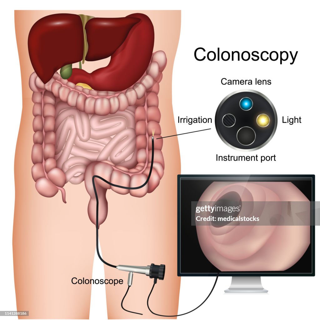 Colonoscopy Tutorial Colonoscopy Procedure Labeled 3d Vector Diagram On White Background ...