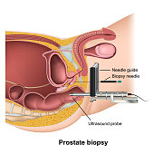 Prostate biopsy medical healthcare vector illustration on white background