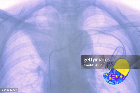 Substernal Pacemaker Pacemaker implanted in the chest. Frontal chest x-ray. News Photo ...