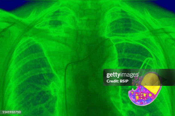 Pacemaker implanted in the chest. Frontal chest x-ray.