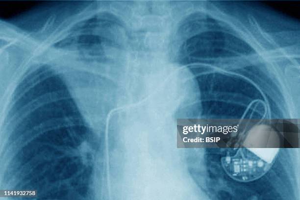 Foto Pacemaker 81 Pacemaker Xray Stock Photos, High-Res Pictures, and Images - Getty ...