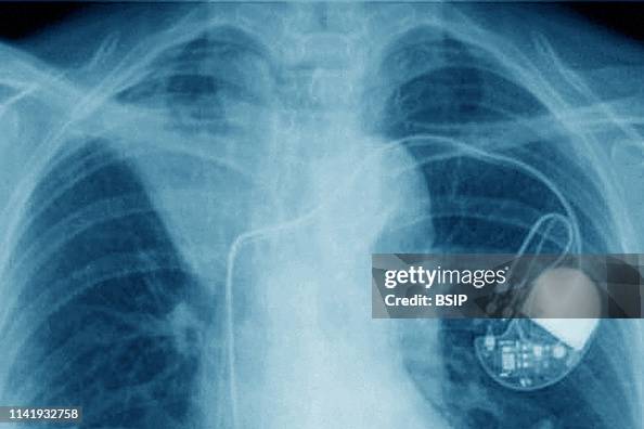 Substernal Pacemaker Pacemaker implanted in the chest. Frontal chest x-ray. News Photo ...