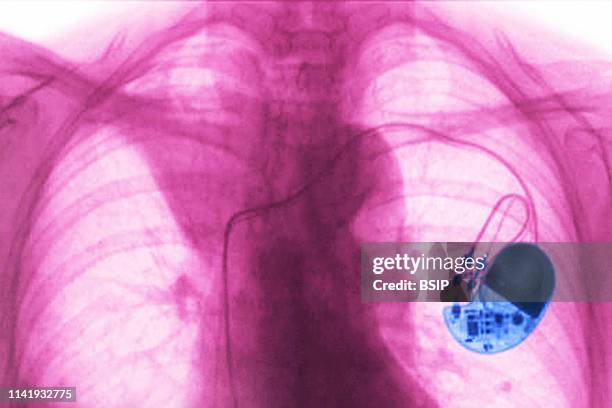 Foto Pacemaker 230 Pacemaker Test Stock Photos, High-Res Pictures, and Images - Getty ...