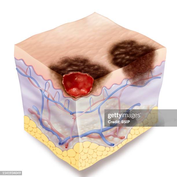 Illustration of a stage 1 melanoma. The melanoma has irregular serrated edges. Two types of stage 1 melanoma are illustrated: On the left, it is...